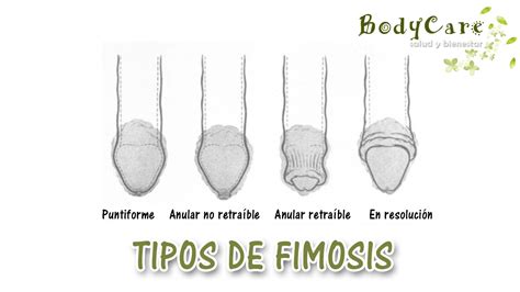 fimosis imagenes|Imágenes